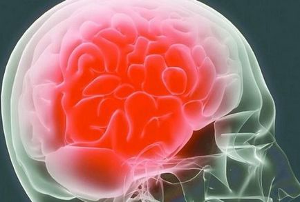 Постоянни главоболия причиняват и естеството на симптомите