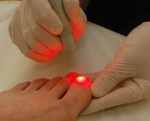 Предимства на лазерно лечение на врастнали нокти