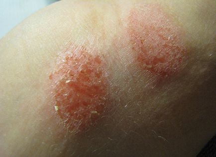 Причините за алергия - поява при възрастни, уртикария, по врата, дланите, кожата на лицето