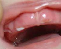 Никнене на млечни зъби - причини, симптоми, диагностика и лечение