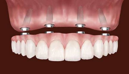 Ортопедична зъби в цената на отсъствие, функции