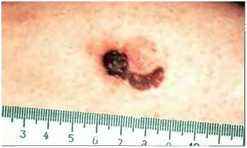 Рак на кожата, меланома - причини, симптоми и лечение