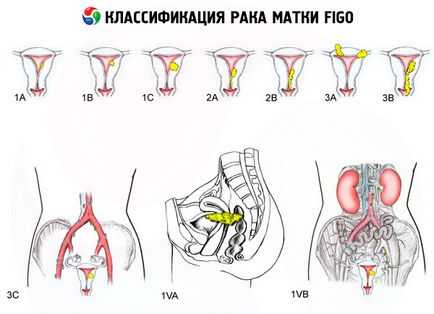 рак на матката причинява симптомите, диагностика, лечение, които са компетентни за здравето на ilive