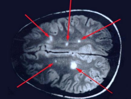 Множествената склероза на функции ядрено-магнитен резонанс и диагностика на множествена склероза