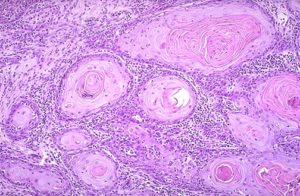 Дешифрирането на резултатите от рак на маточната шийка биопсии