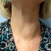 Регионални или регионални лимфни възли на щитовидната жлеза