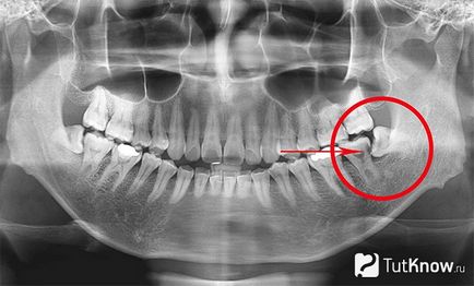 Изрежете мъдрец премахване на болката, какво да правя