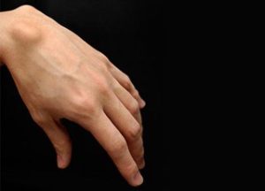 Пъпки по ръцете под кожата на дланта на ръката си и предмишницата - причините (снимки)