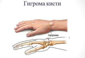 Пъпки по ръцете под кожата на дланта на ръката си и предмишницата - причините (снимки)