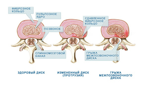 Симптомите на гръбначния херния, причини и как да се отнасяме лумбалния гръбначен херния