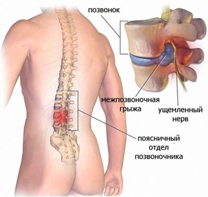 Симптомите на гръбначния херния, причини и как да се отнасяме лумбалния гръбначен херния