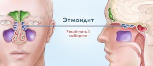 Симптоми и лечение etmoidita и gaymoroetmoidita патогени и каузи, класификация и знаци