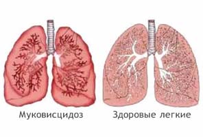 Симптомите на кистозна фиброза при деца и възрастни