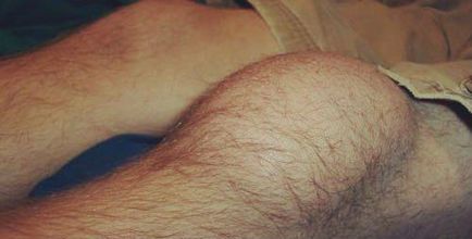 Синовиалната течност в колянната става лечение, симптомите и причините