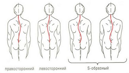 видове сколиоза, причини, признаци, симптоми и лечение