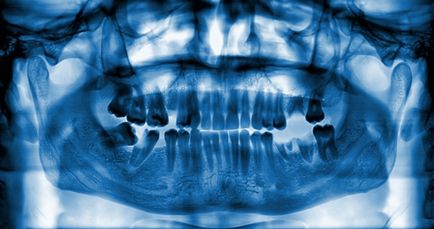 Скърцане със зъби по време на сън - което е защо това се случва