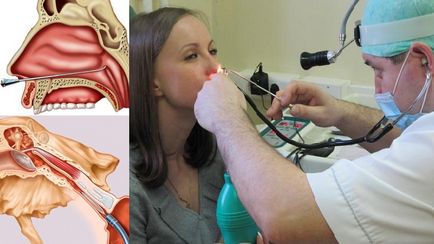 Маточните тръби, възпаление на средното ухо симптоми и лечение за възрастни, как да се отнасяме и причини