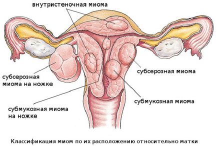 Отстраняване на матката миома с коментари последици