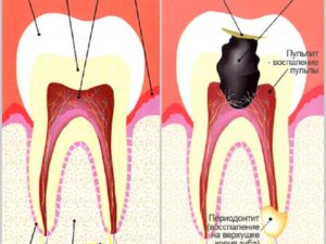 Зъб нерв на зъба от лечение, тъй като защо и колко време отстраняване на последиците от