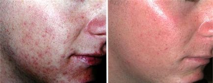 Невероятна снимка лазерно лечение на акне преди и след