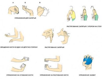Упражнение след счупена ръка у дома, как да се развива