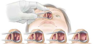 Vasotomy конхи какво е, причинява операция в долната част на носа и нейните видове