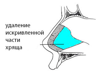 Vasotomy спирална кост, назално субмукозно резекция