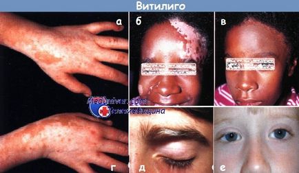 Витилиго - отпечатък аура или заболяване, от което се появяват върху кожата белите петна