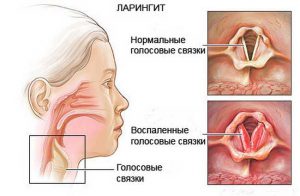 Възпалението на гласните струни симптоми и лечение