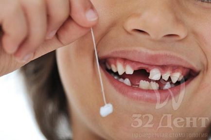 Възможно ли е подмяна на зъбите на импланти