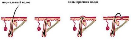 Растат косми след епилация - какво да правя