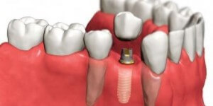 Поставете видове зъбни процедури и техните цени