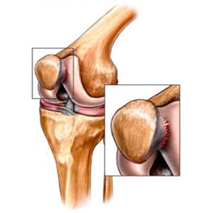 Chondromalacia патела (колянна става) - степен третиране