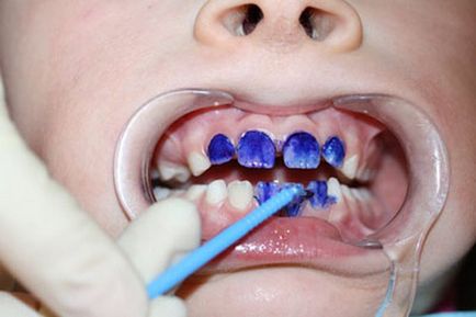 Защо сребърни зъби деца метод архаичен поколение млечни продукти на защита