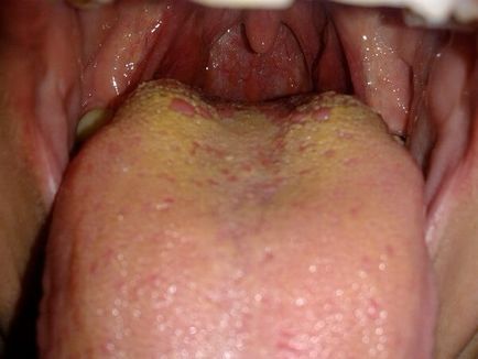 Жълт плака върху езика при възрастни води, третирането, какво означава това, и свързаните с него симптоми