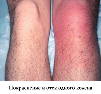 Течността в съвместните причини коляното и лечение, симптоми, диагностика