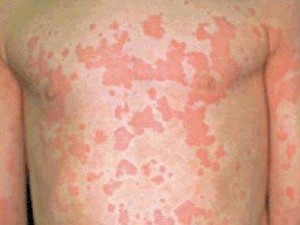 Алергия към пот - симптоми, причини и лечение