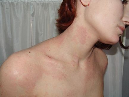 Алергични към химикали - симптоми и лечение