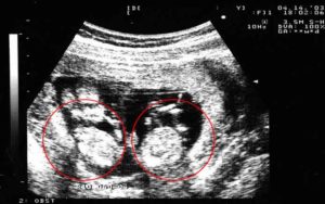 Бременност с близнаци, както се оказва, как да се идентифицират