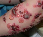 Булозен дерматит - причини, симптоми, диагностика и лечение