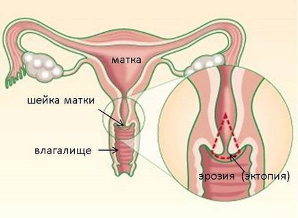 Маточната ерозия - Симптоми, причините, за лечение