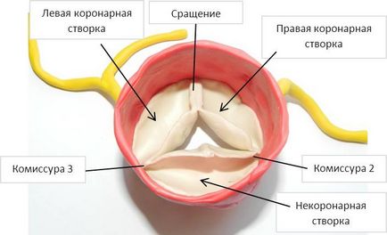 Фиброза на аортна клапа листовки (вентил) Фиброза на аортната клапа