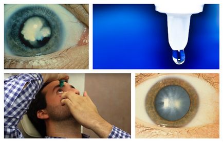 Капки за очи с катаракта пълен списък и селекция от най-добрите