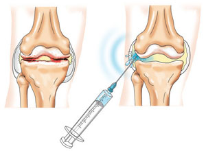 Остеоартрит на коляното съвместно лечение на заболяване