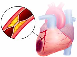 Как да разпознаем появата на инфаркт