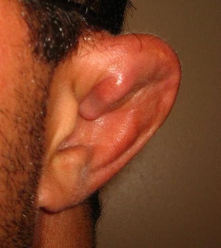 Как да се прекъсне ухото може да увреди хрущяла Смятате