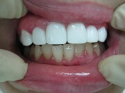 Как да се съгласуват зъбите без презрамки, които могат да бъдат използвани у дома