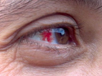 Кръвоизливи в очите, лечение (какво да се прави), причини, симптоми