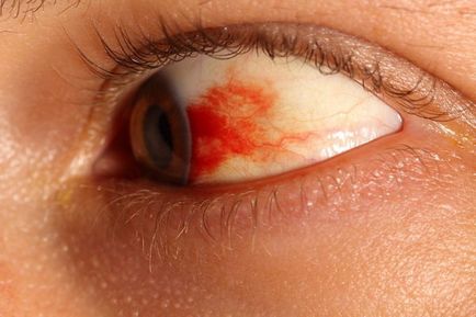 Кръвоизливи в очите, лечение (какво да се прави), причини, симптоми