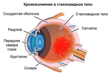 Кръвоизливи в очите причините и лечения, които правят, прогноза